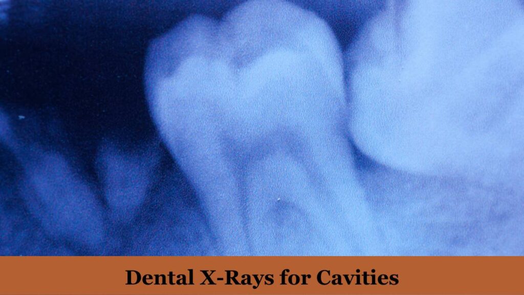  Dental X-Rays for Cavities