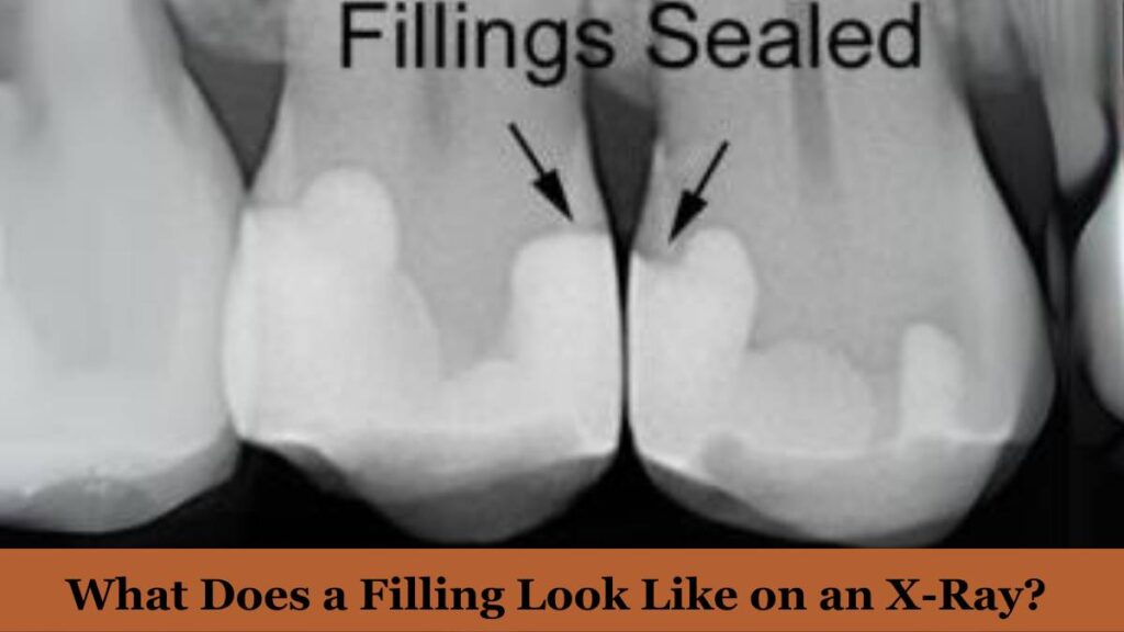 What Does a ‘Cavity’Look Like on an X-Ray?