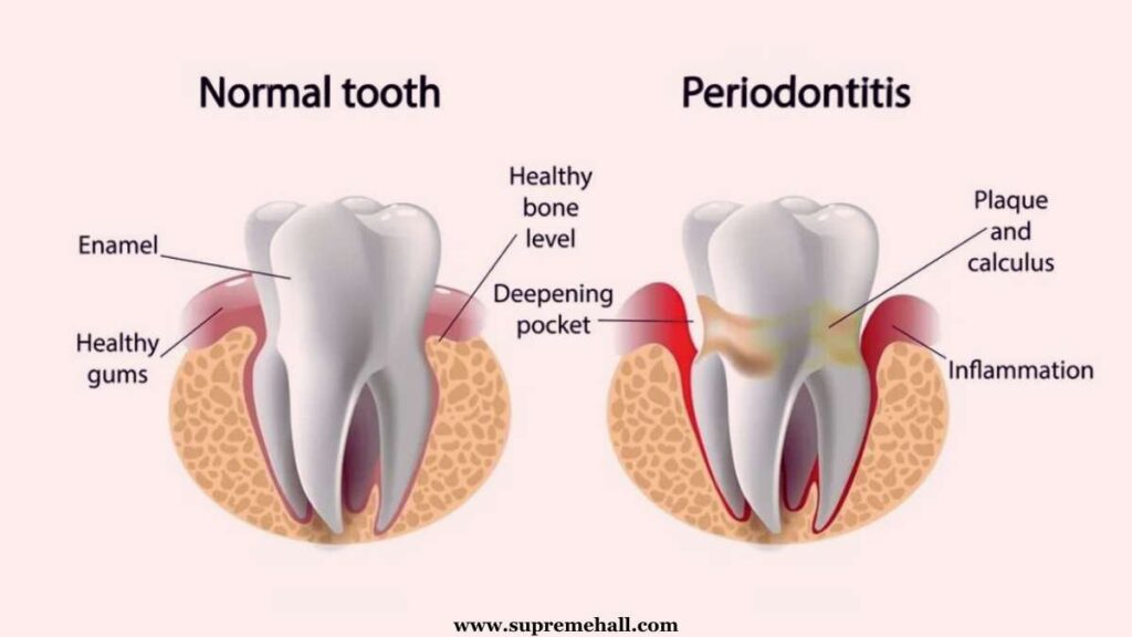 Normal tooth vs Periodontitis