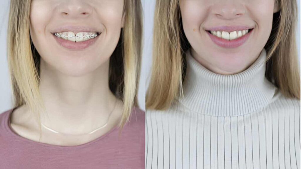 Jawline Before and After Braces Face Shape